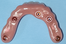 Before detail, Lower Implant Hybrid Denture