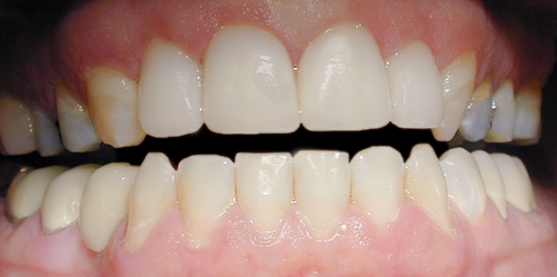After Four Conservative Veneers, Mary