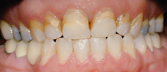 Before Four Conservative Veneers, Mary