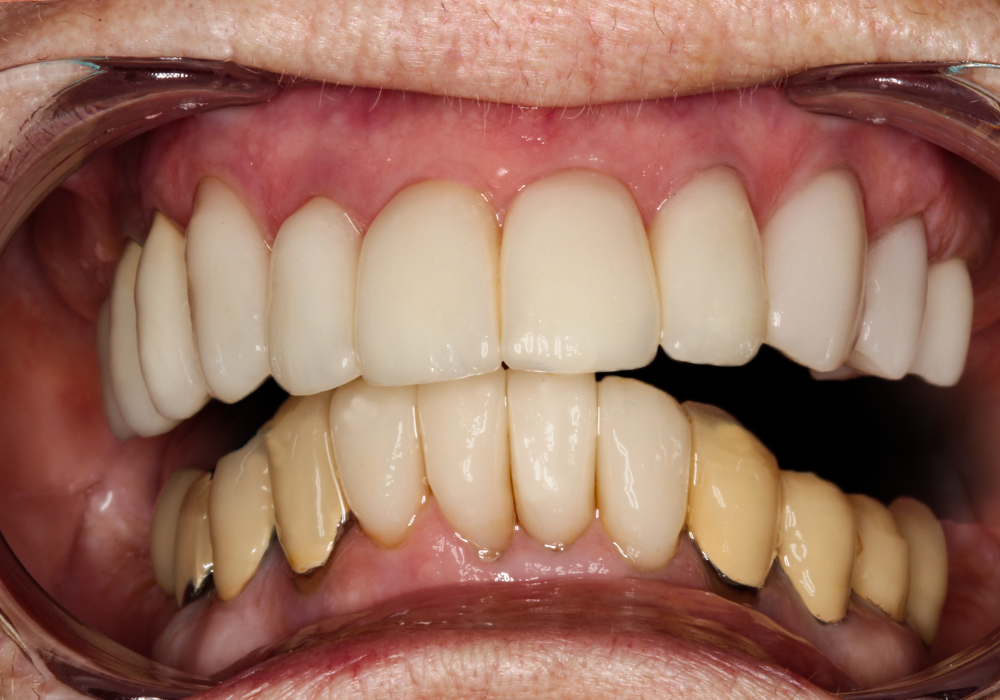 After Smile Makeover, Maureen