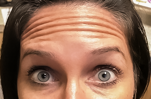 Before BOTOX®, Melissa