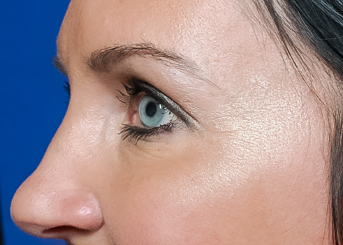 After detail, BOTOX®, Melissa