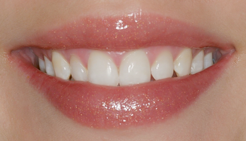 Before Ten Upper Veneers to Even Teeth-miss Georgia