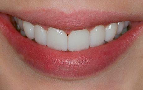 After Ten Upper Veneers to Even Teeth-miss Georgia