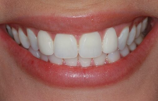 After Two Veneers, Miss Georgia