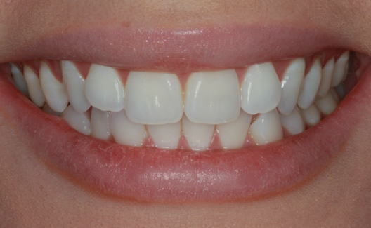 Before Two Veneers, Miss Georgia