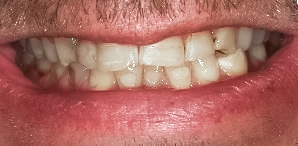 Before detail, Full Mouth Reconstruction, Loren