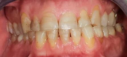 Before Full Mouth Reconstruction, Loren