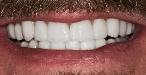 After detail, Full Mouth Reconstruction, Loren