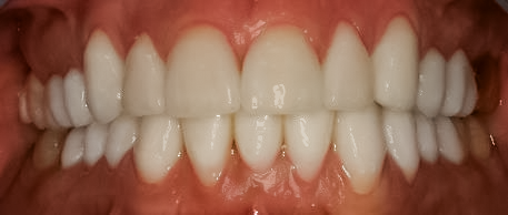 After Full Mouth Reconstruction, Loren