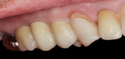 After detail, Multiple Posterior Implants