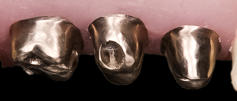 Multiple Posterior Implants
