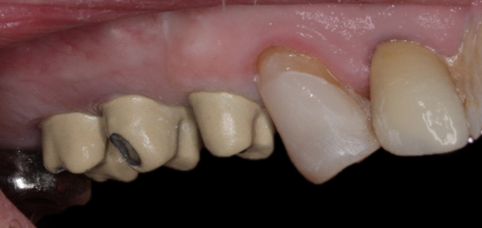 Before detail, Multiple Posterior Implants