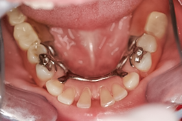 After detail, Partial Dentures