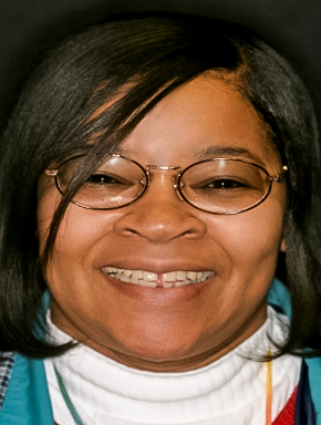 Partial Dentures