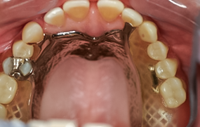 Before detail, Partial Dentures