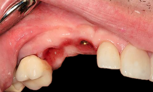 Before detail, Veneers, Crowns & Implants, Paul