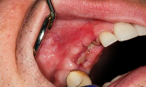 Before detail, Veneers, Crowns & Implants, Paul