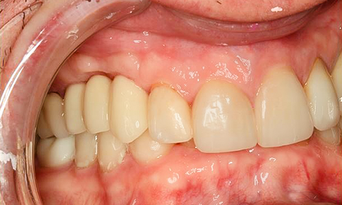 After detail, Veneers, Crowns & Implants, Paul