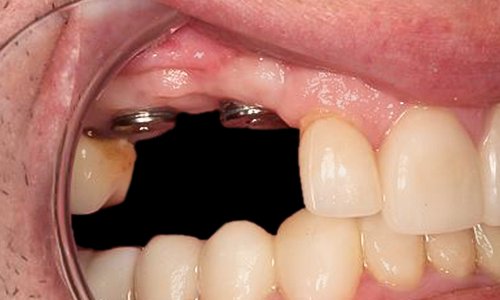 After detail, Veneers, Crowns & Implants, Paul