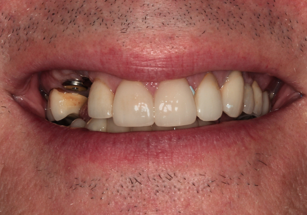 Before Veneers, Crowns & Implants, Paul