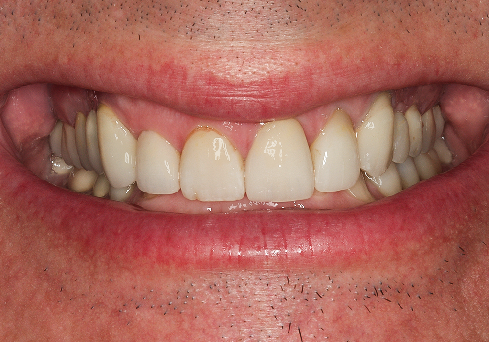 After Veneers, Crowns & Implants, Paul