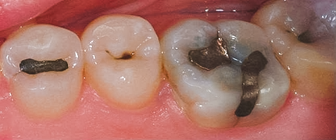 Before Posterior Onlays & Fillings