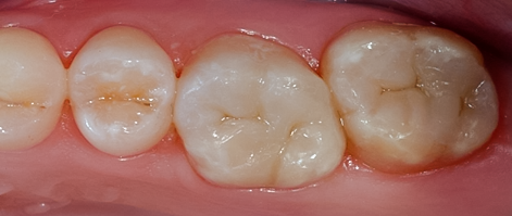 Posterior Onlays & Fillings