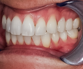 After detail, Premolar Veneers No-prep