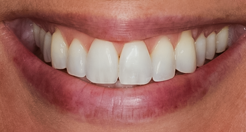 After Premolar Veneers No-prep