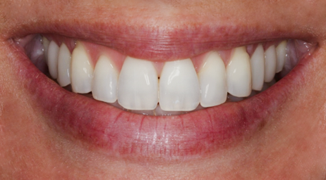 Before Premolar Veneers No-prep