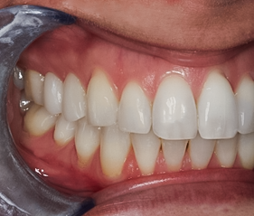 Before detail, Premolar Veneers No-prep