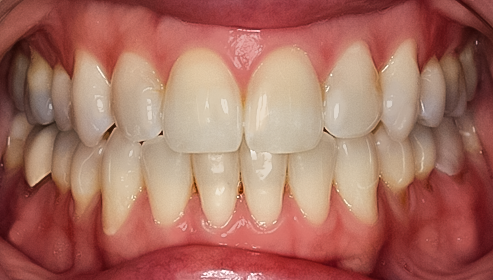 Invisalign®, Rebecca
