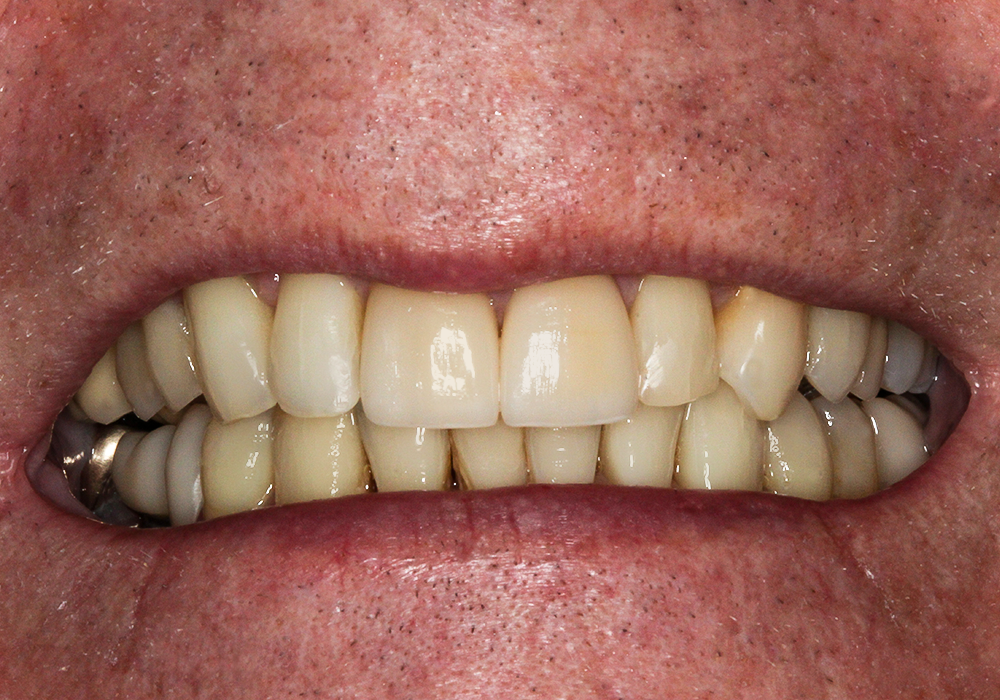 After Invisalign®, Veneers & Crowns, Rick