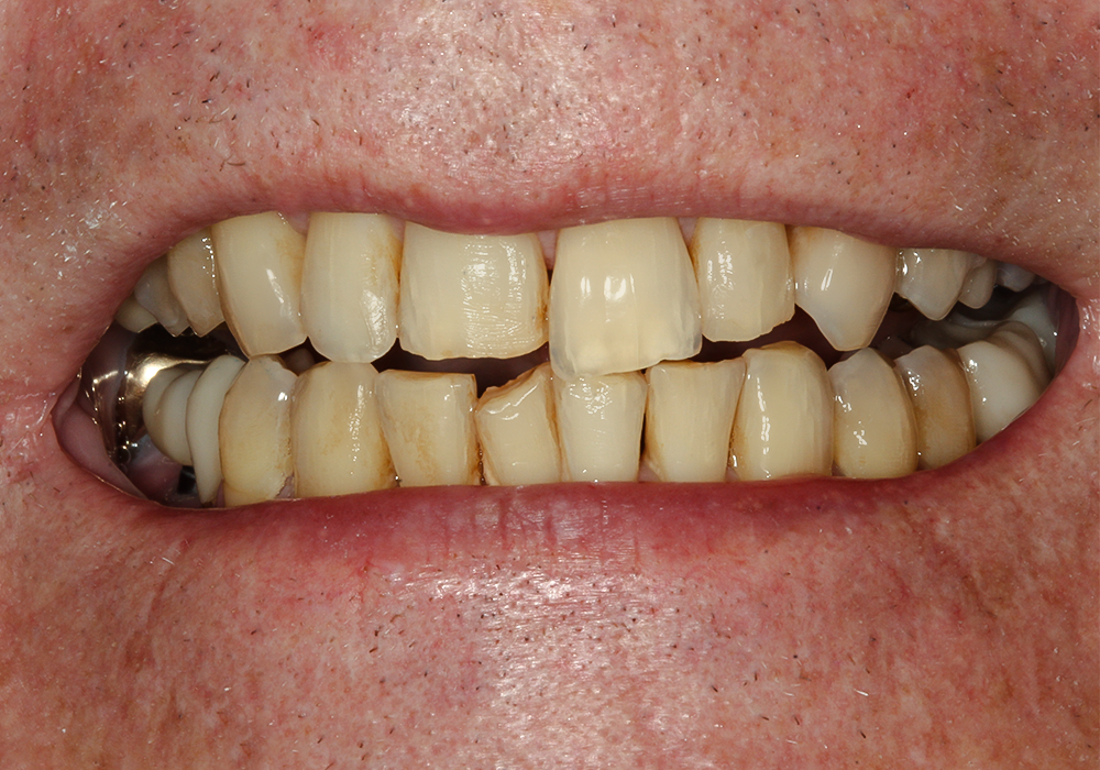 Before Invisalign®, Veneers & Crowns, Rick