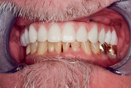 After Full Upper Implant Supported Denture, 67-YEAR-OLD (ron)