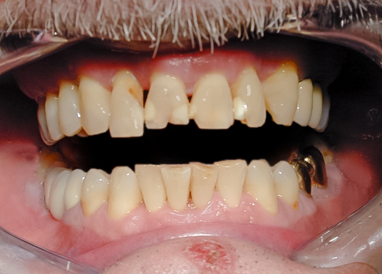 Before Full Upper Implant Supported Denture, 67-YEAR-OLD (ron)