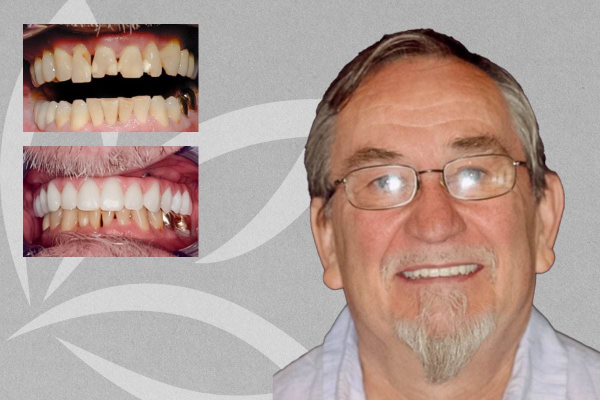 Full Upper Implant Supported Denture, 67-YEAR-OLD (ron) featured transformation