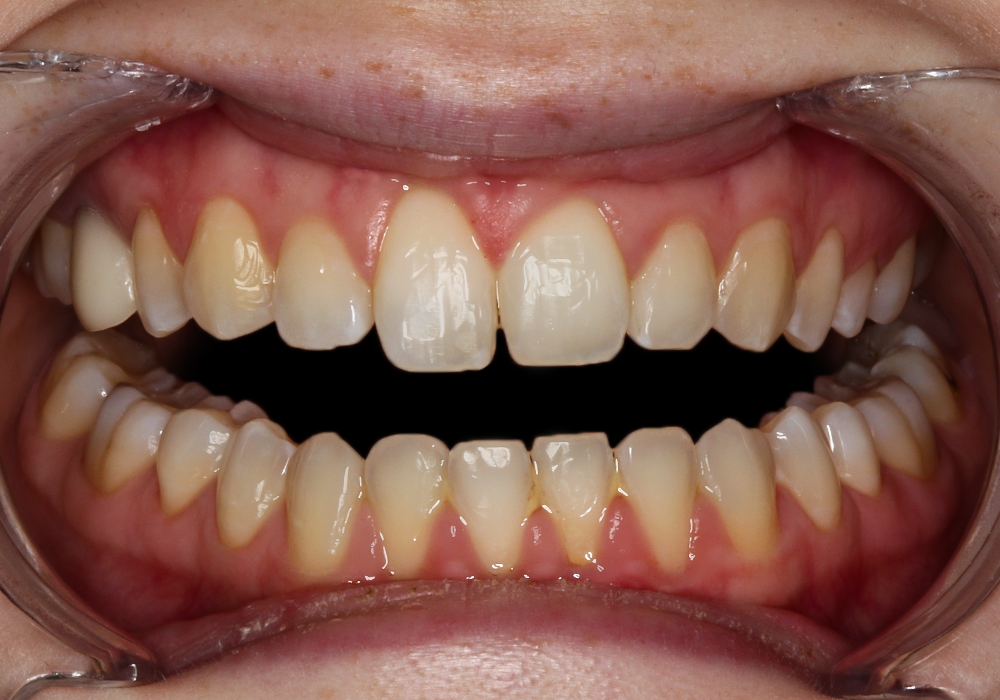 Before Veneers, Samantha