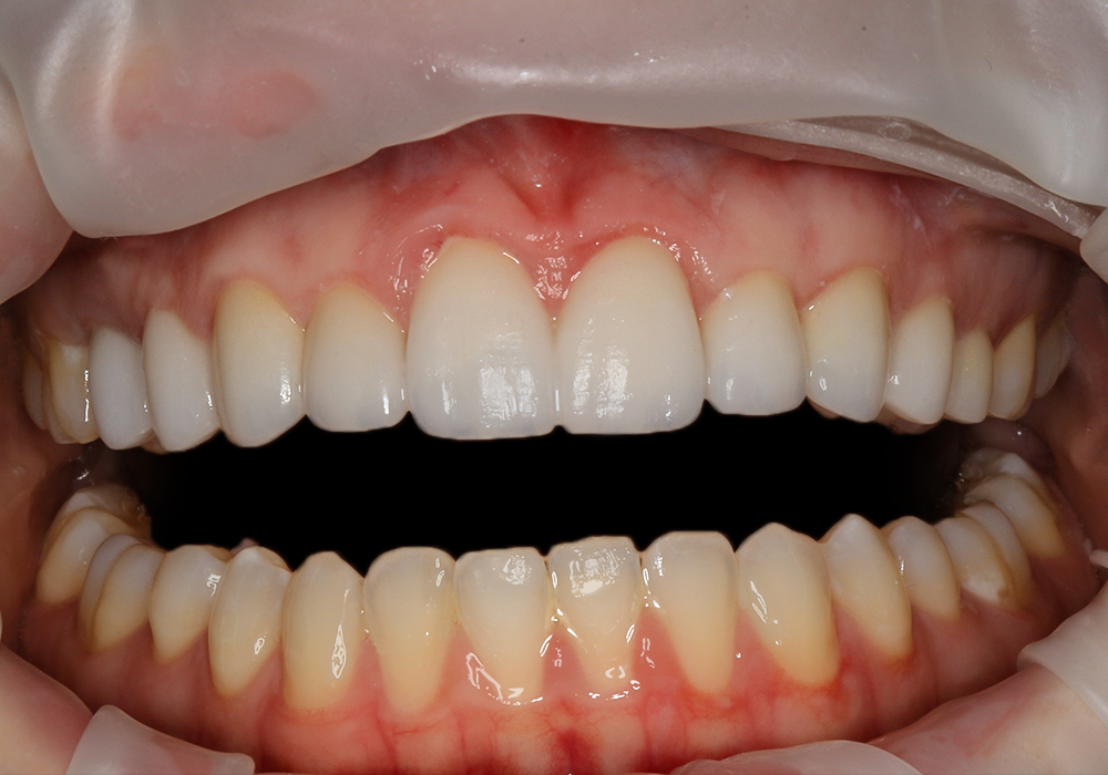 After Veneers, Samantha