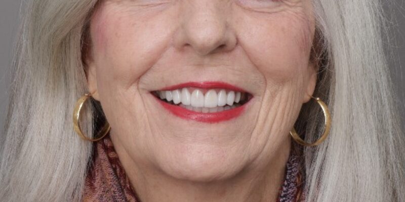 After Sandra, Smile Makeover