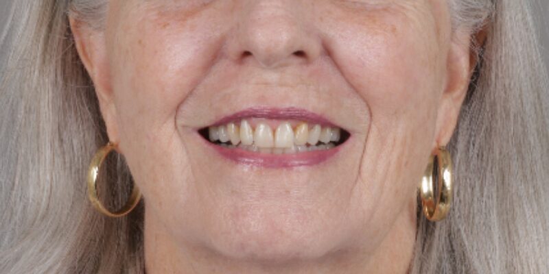 Before Sandra, Smile Makeover
