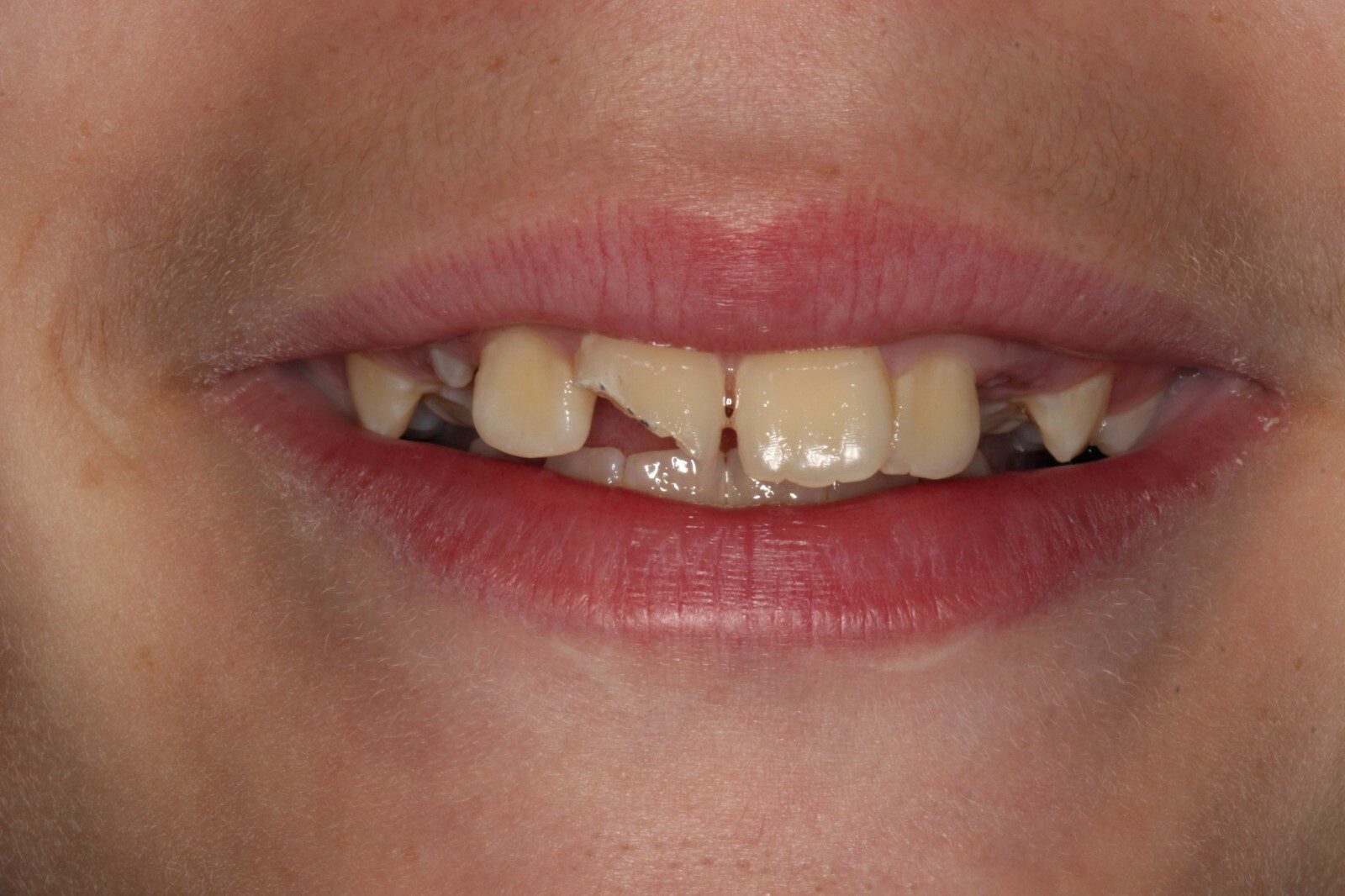 Before Seamless Smile Repair After a Fall