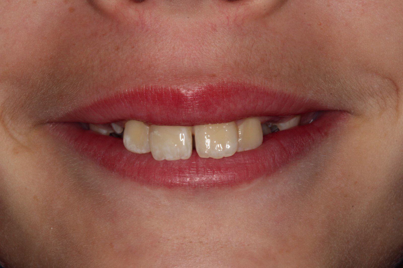 After Seamless Smile Repair After a Fall