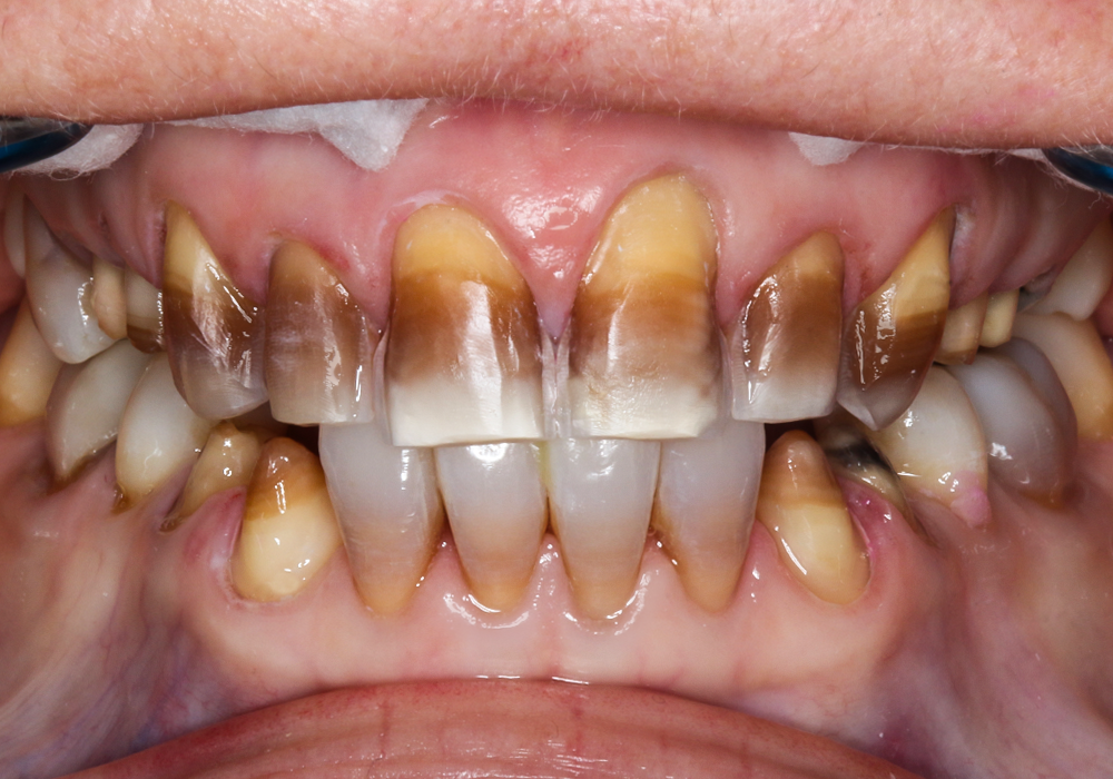 Before Veneers & Crowns, Sharon