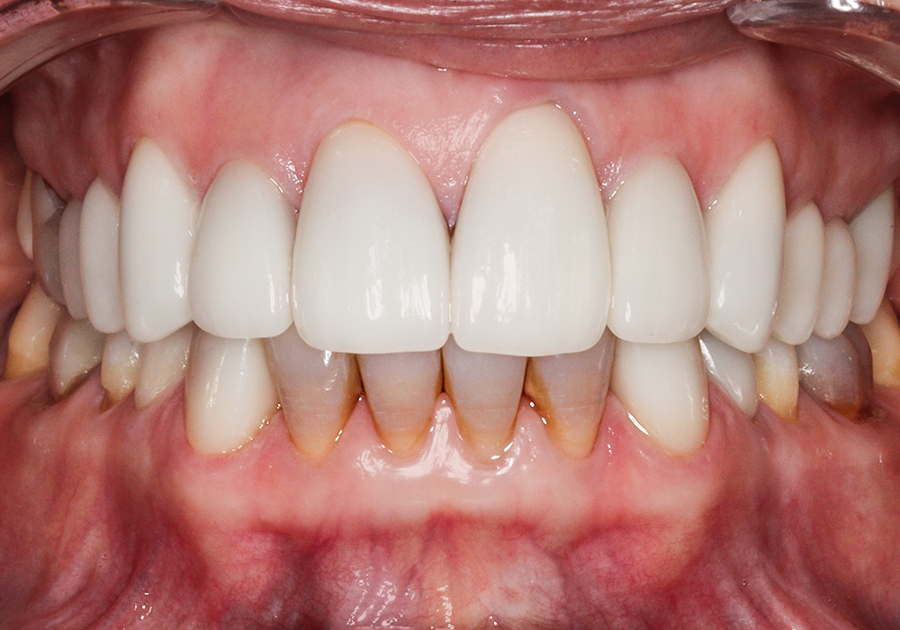 After Veneers & Crowns, Sharon