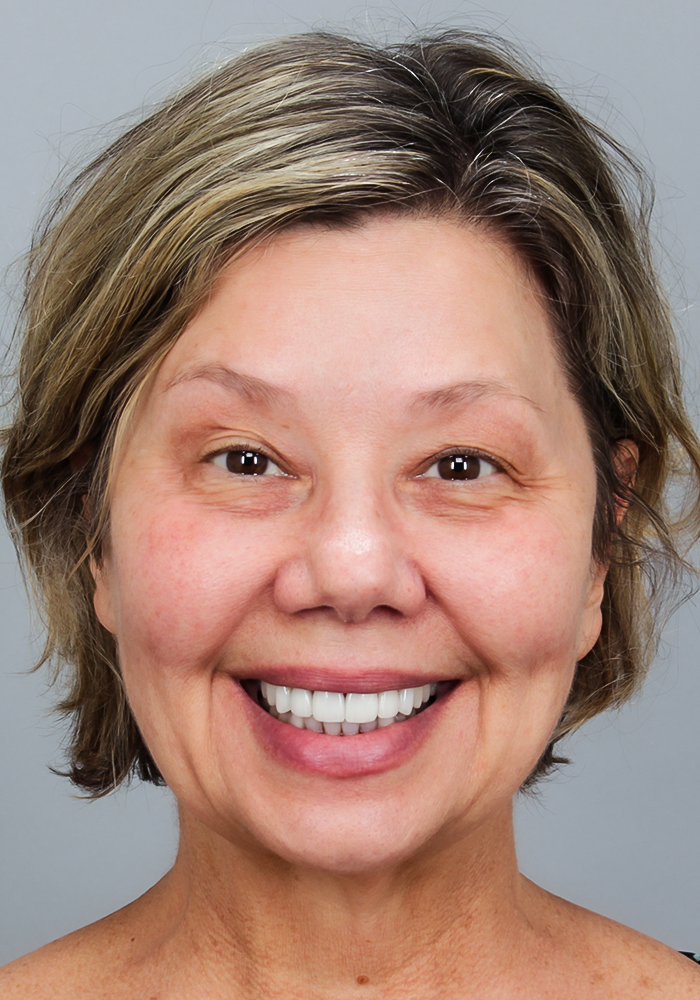 After detail, Veneers & Crowns, Sharon