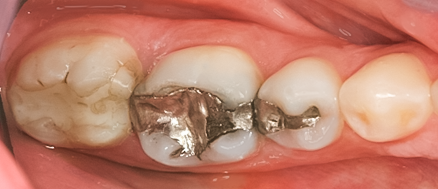 Before Silver Fillings Replaced With Onlays