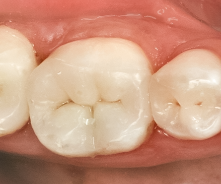 Silver Fillings Replaced With Onlays