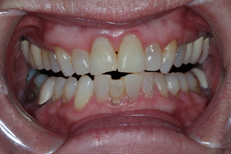 Before Single Lower Veneer, to Straighten